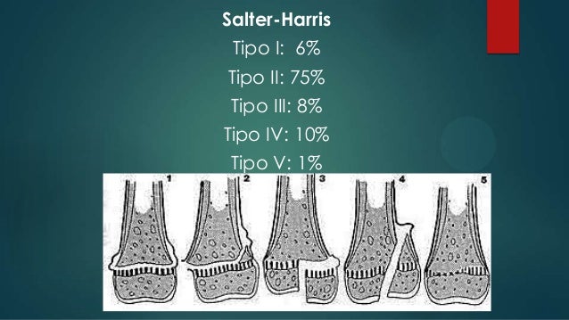 epifisiolisis traumatica